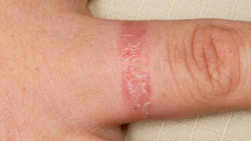 eczema contact dermatitis