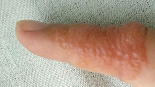 eczema Dyshidrotic dermatitis