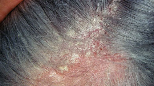 eczema Seborrheic dermatitis