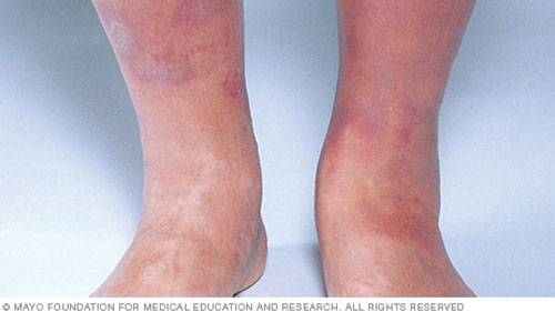 eczema stasis dermatitis